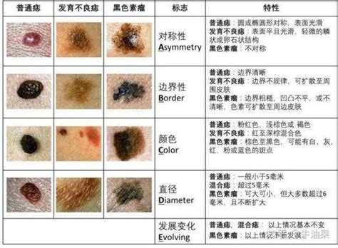 臉部痣|痣是什麼？會變成黑色素瘤？7種一定要除的痣